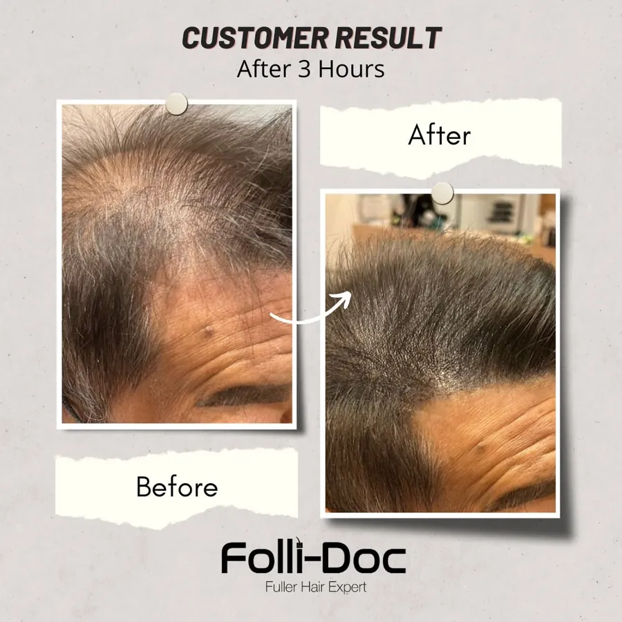 Folli-Doc 客户单次疗程前后对比