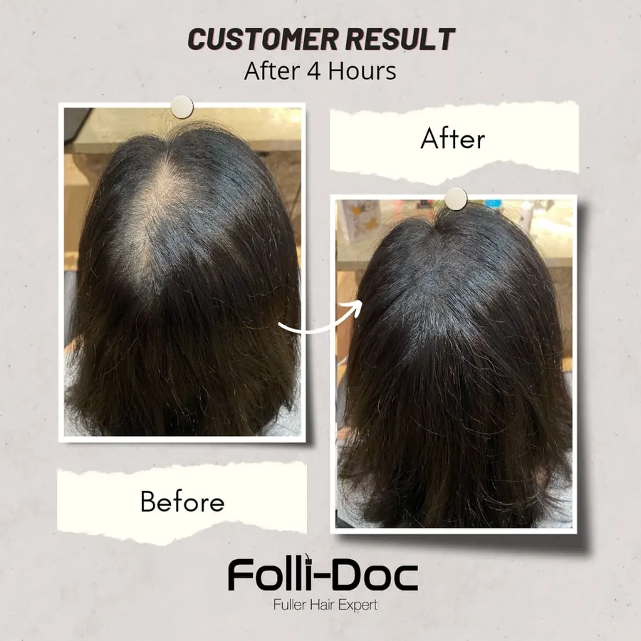 Folli-Doc 客户单次疗程前后对比