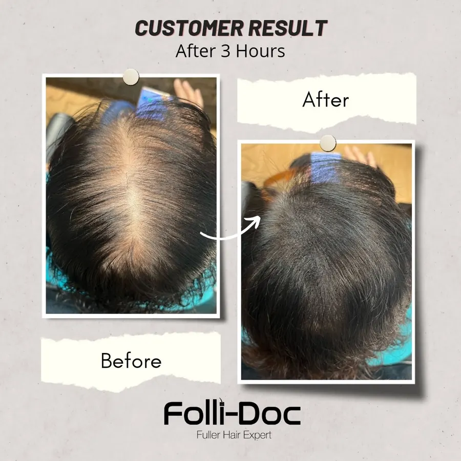 Folli-Doc 客户单次疗程前后对比