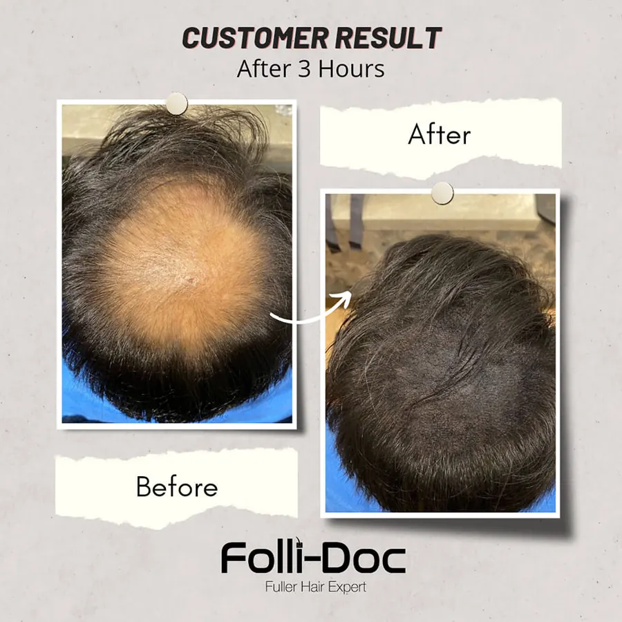 Folli-Doc 客户单次疗程前后对比