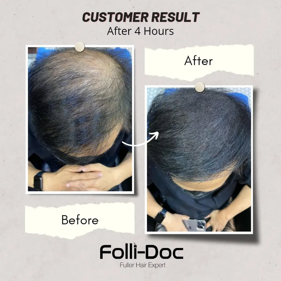Folli-Doc 客户单次疗程前后对比