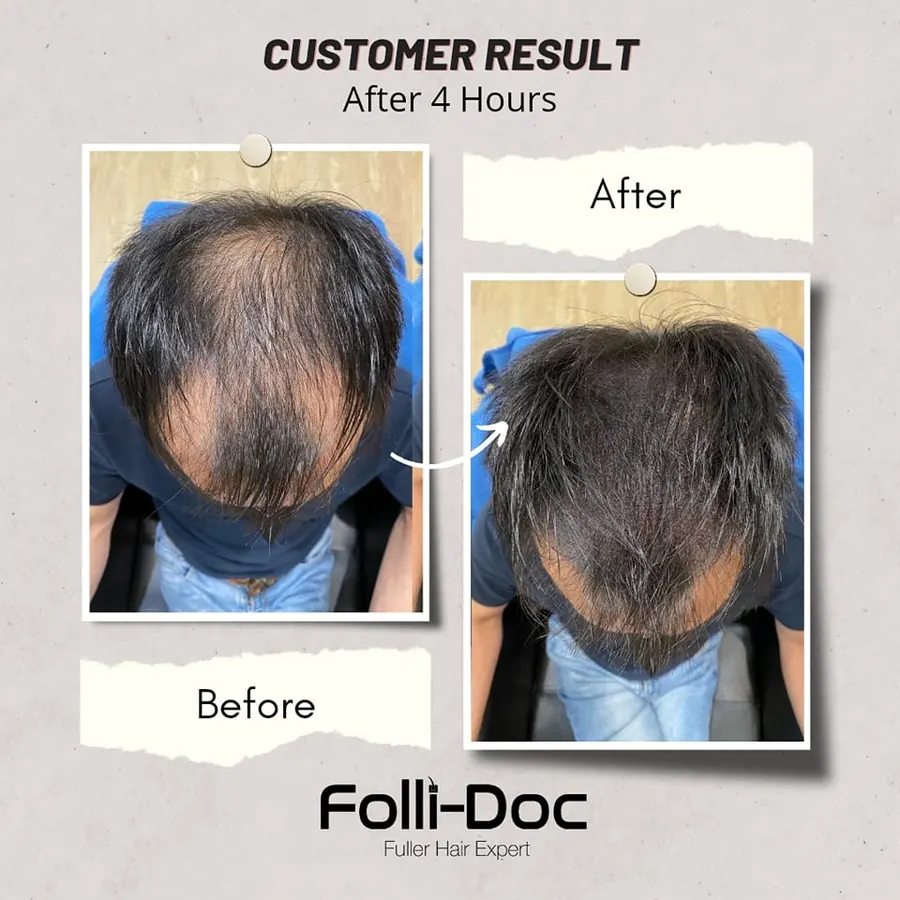 Folli-Doc 客户单次疗程前后对比