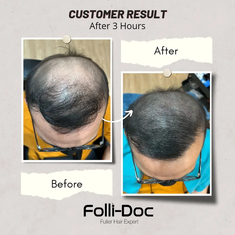 Folli-Doc 客户单次疗程前后对比