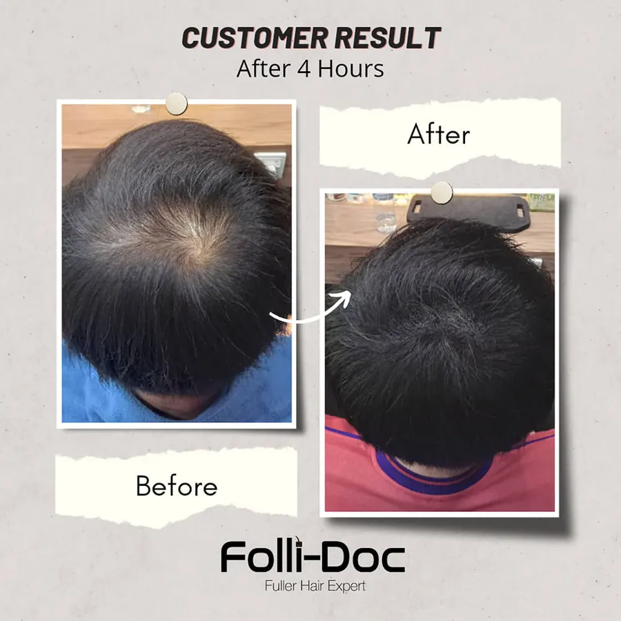 Folli-Doc 客户单次疗程前后对比
