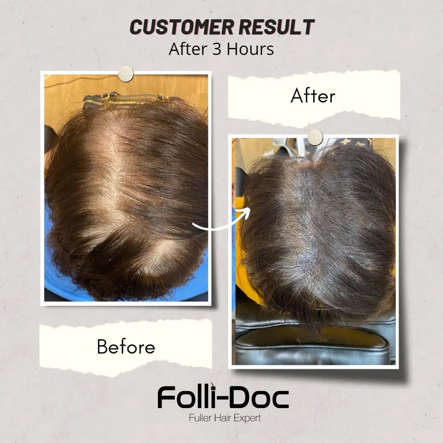 Folli-Doc 客户单次疗程前后对比