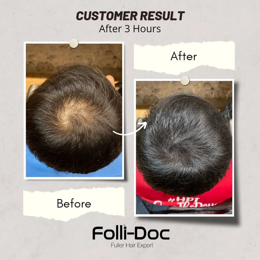 Folli-Doc 客户单次疗程前后对比
