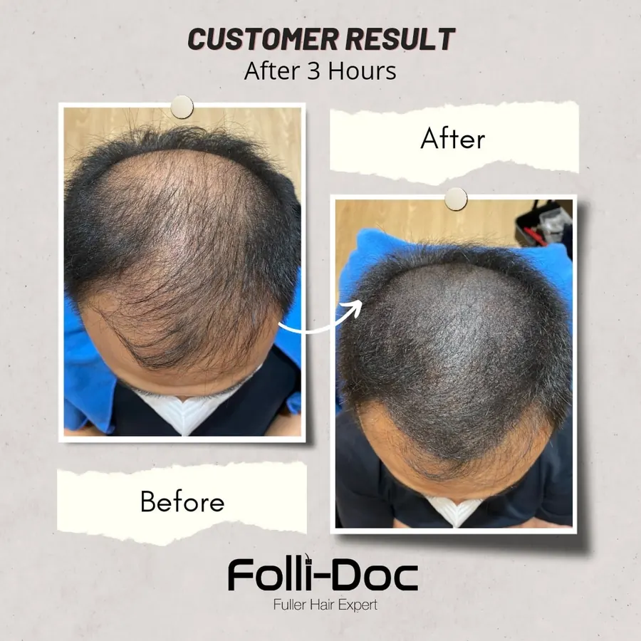Folli-Doc 客户单次疗程前后对比