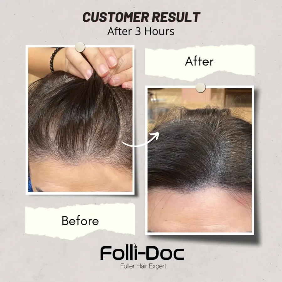 Folli-Doc 客户单次疗程前后对比