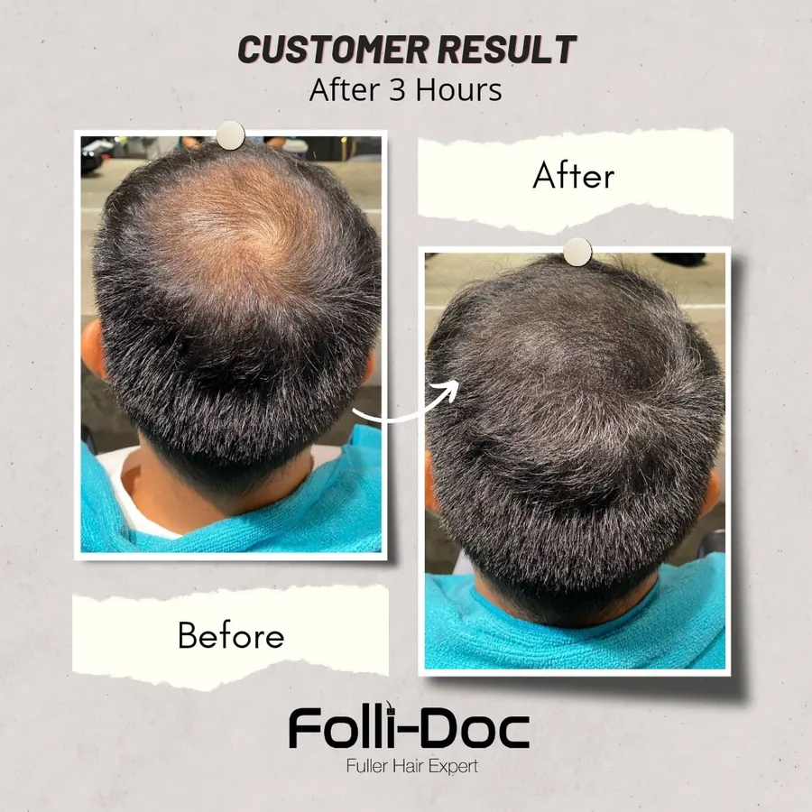 Folli-Doc 客户单次疗程前后对比