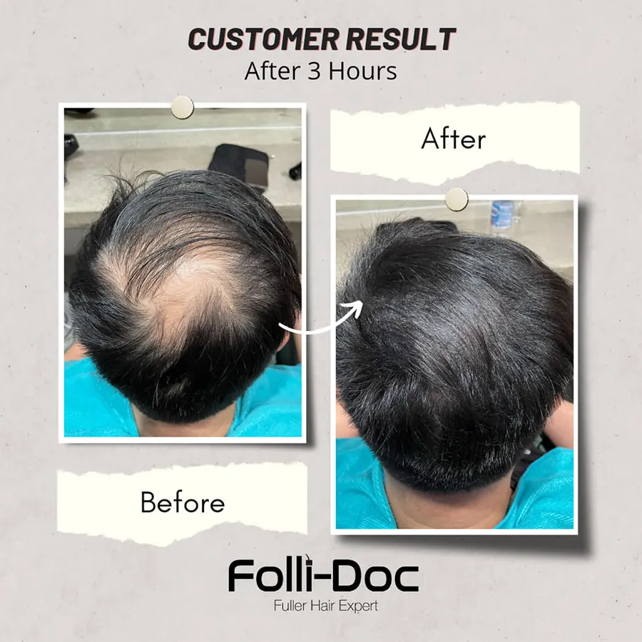 Folli-Doc 客户3–4小时后的效果